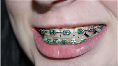 Can you Chewing Gum with Braces